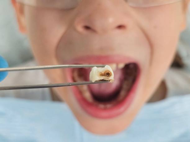 Best Emergency Wisdom Teeth Removal in Osceola, AR